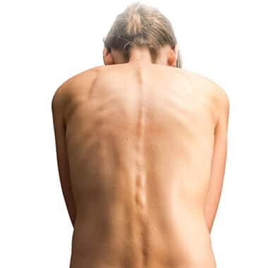 Womas back showing Scoliosis
